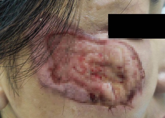 V&ugrave;ng da bị lở lo&eacute;t, mưng mủ sau khi sử dụng thuốc kh&ocirc;ng c&oacute; nguồn gốc