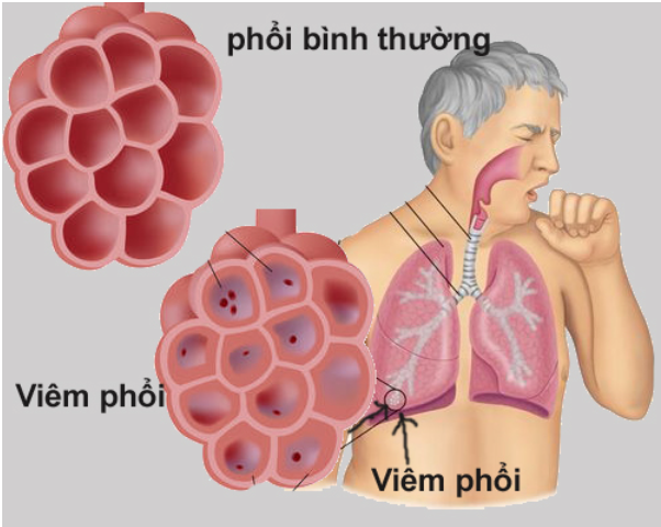 Ảnh minh họa: Bộ Y tế